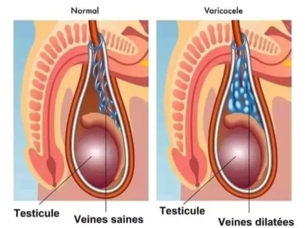 Varivax plus forte