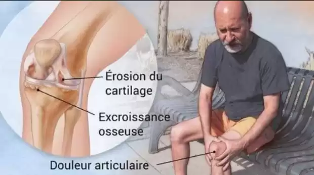 Arthro SupReviver Longrich | IZICAMER
